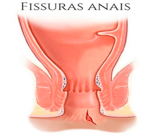 fissura-anal2